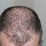 Best Products for Hair Loss (Alopecia) in India