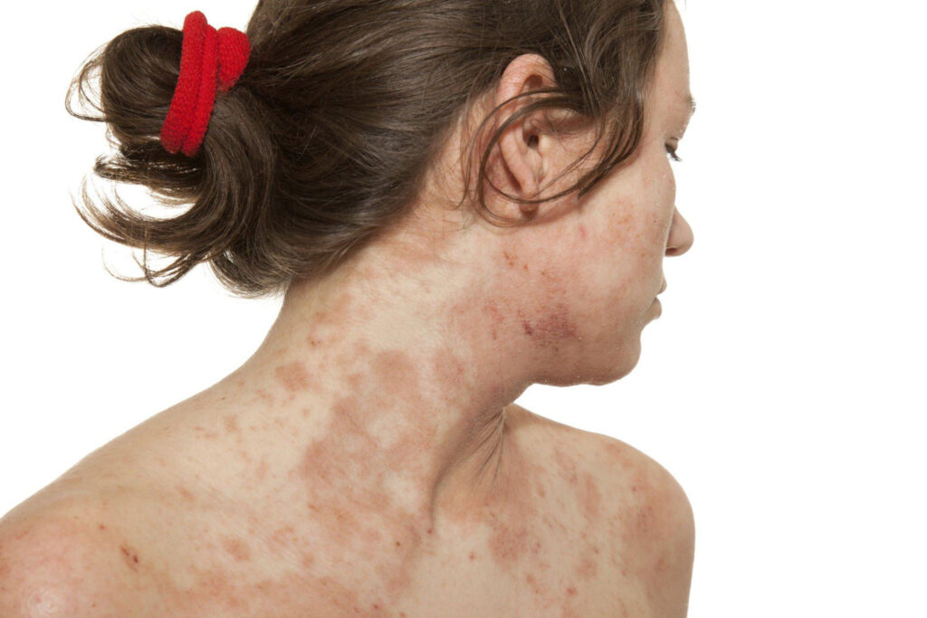 Dermatitis : Causes, Types, Treatments & Prevention