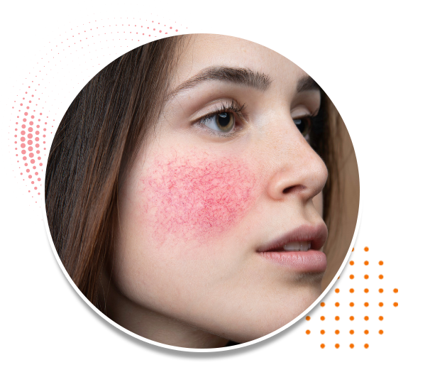 Rosacea