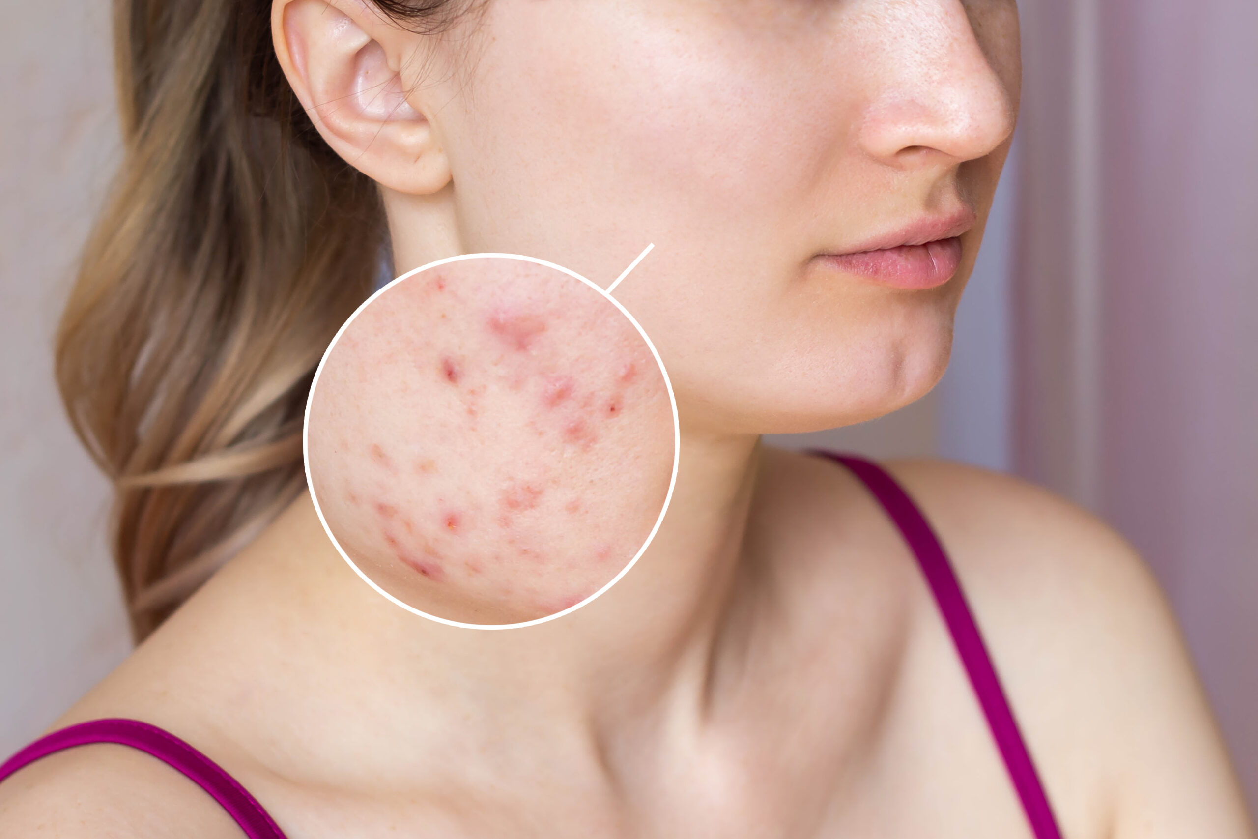 cropped shot young womans face with acne skin zoom circle pimples red scars rash cheeks scaled