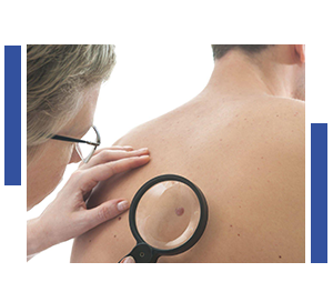Skin-Cancer-Risk