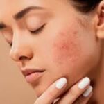 acne cosme